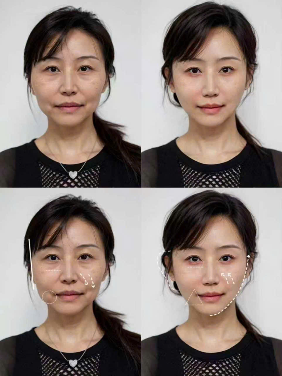 Thu gọn khuôn mặt