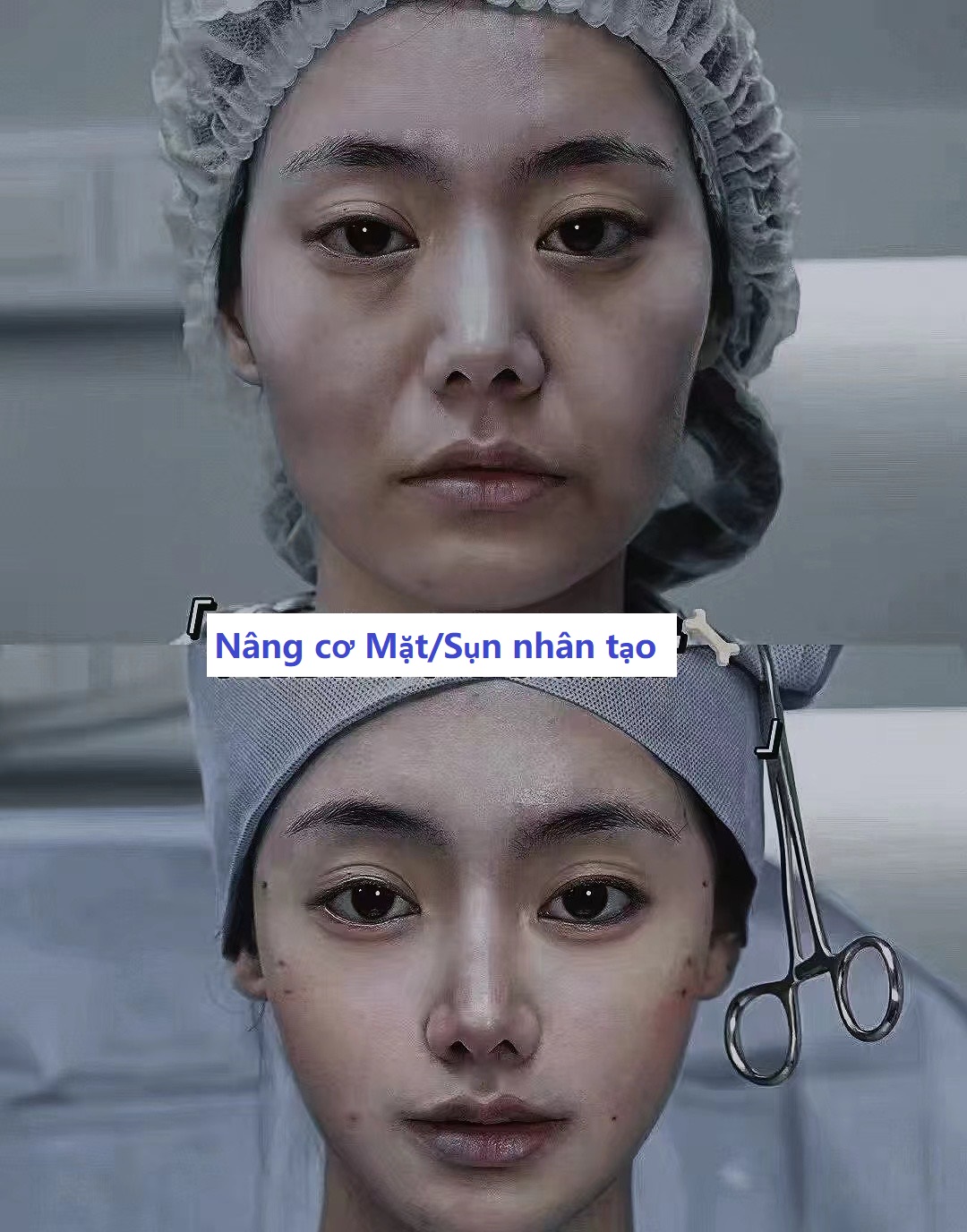Nâng cơ mặt (trước và sau)