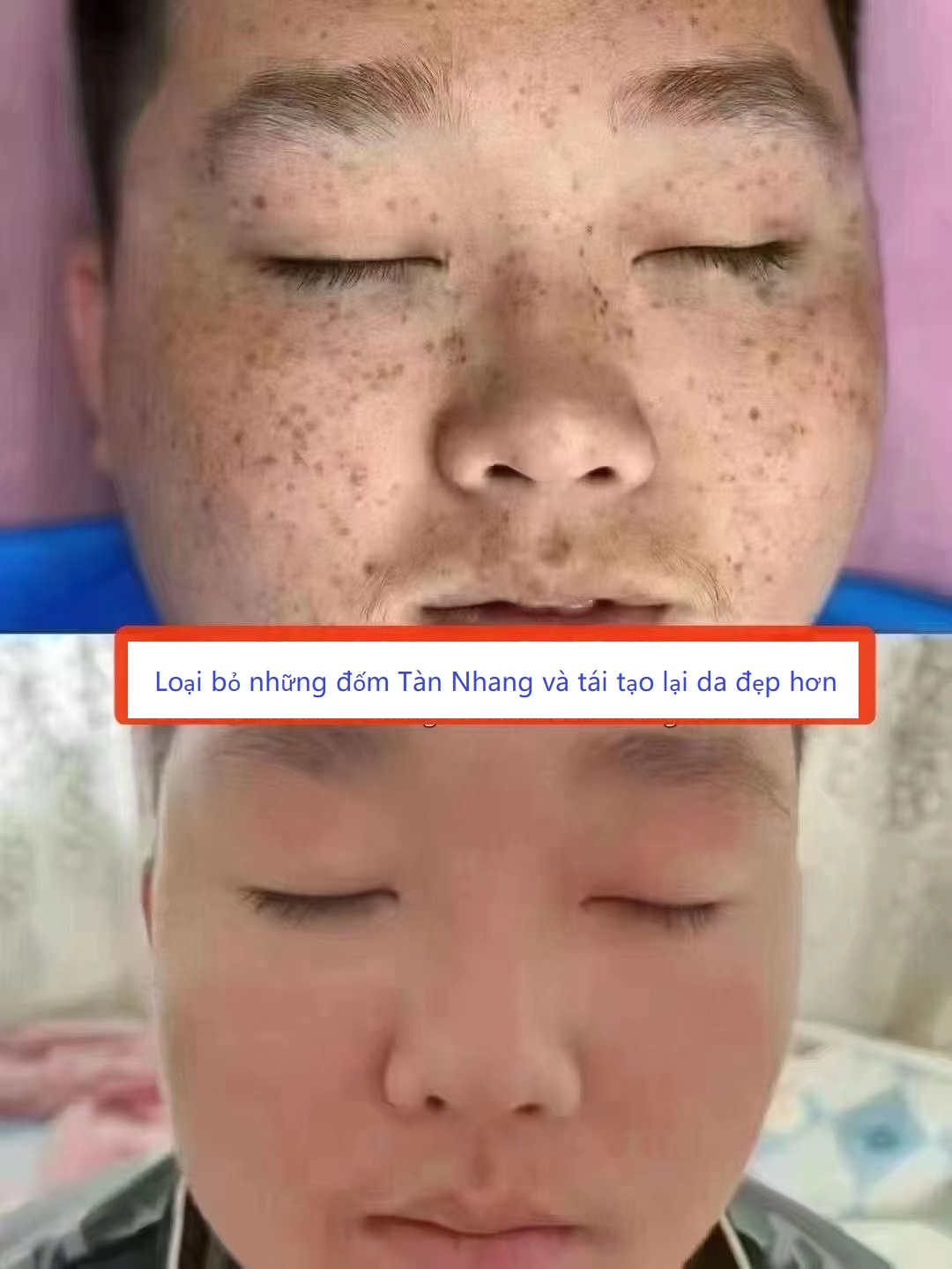 Laser vi điểm xóa nám-tàn nhang