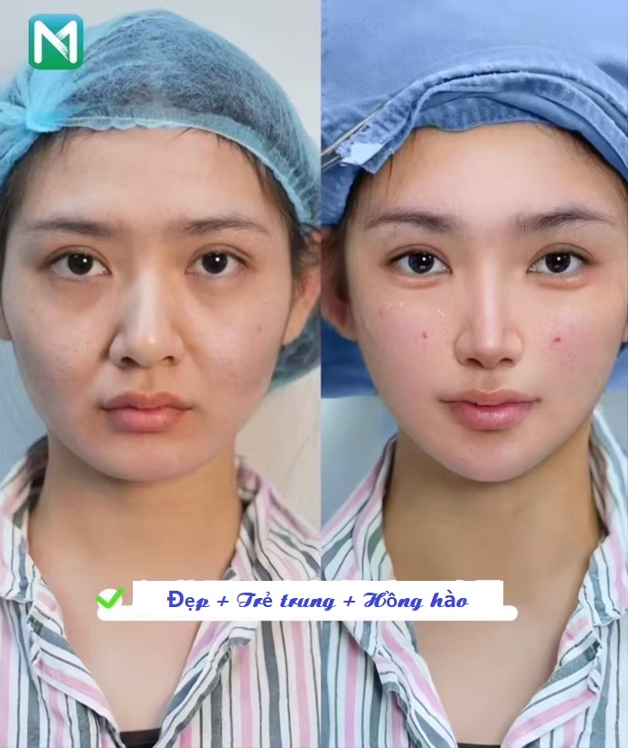 Xử lý vết chân chim, trẻ trung xinh đẹp hơn