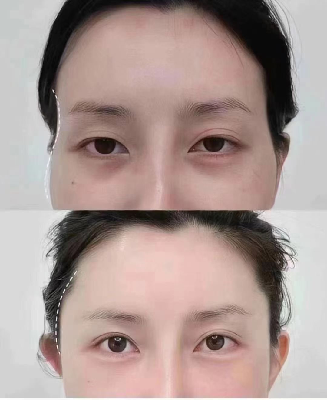 Chỉnh sửa cấu trúc khuôn mặt