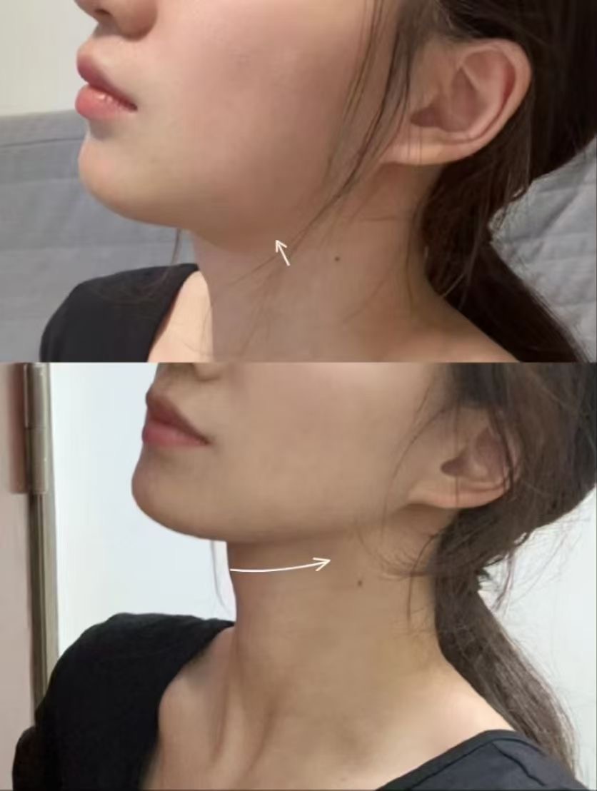 Tiêm botox thon gọn mặt